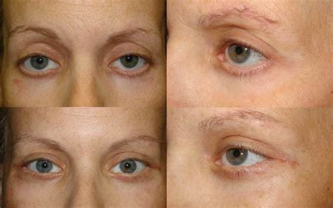 Lower Eyelid Retraction Surgery Dr Guy Massry