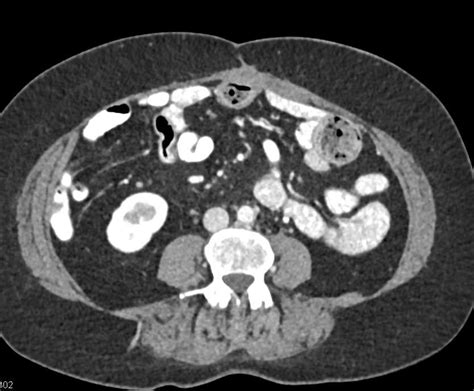 Desmoid Tumor In The Abdominal Wall Musculoskeletal Case Studies