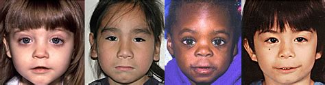 Fetal Alcohol Syndrome American Association For Pediatric Ophthalmology And Strabismus