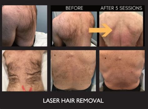 Laser Hair Removal Flemington Permanent Hair Reduction Princeton