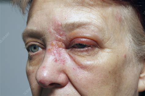 Top 18 First Stage Early Stage Shingles Symptoms Phot