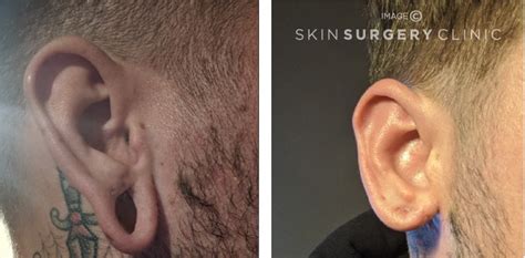 Stretched Earlobe Reconstruction Before After Leeds Js Skin Surgery