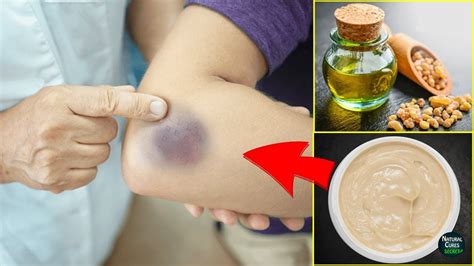 How To Get Rid Of Bruises Fast Natural Bruise Remedies Skin Care