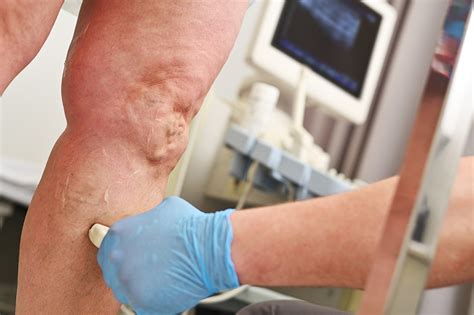 What Causes Leg Discoloration Precision Vascular