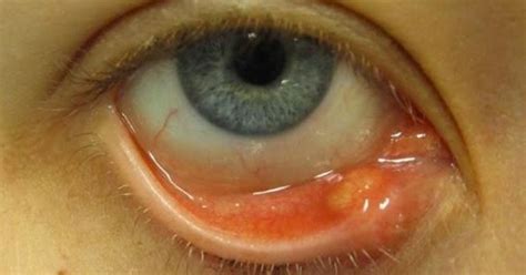 Eyelid Bump Its Causes Symptoms And Treatment Eyelids Lift