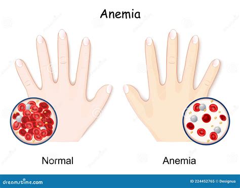 Anemia Hand Of Healthy Human And Anaemia Cartoon Vector Cartoondealer Com