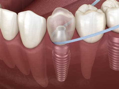 How Long Do Dental Implants Actually Last Are They For Life 【 2021