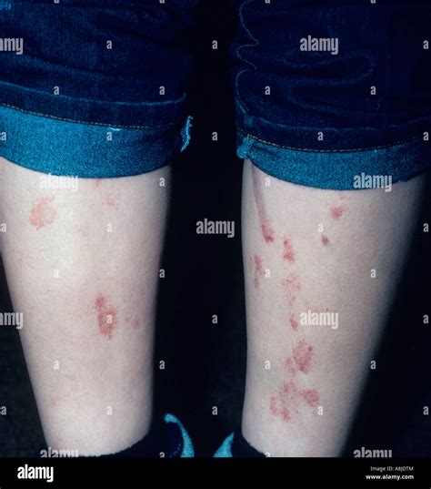 Dermatite Atopica Pruriginosa Immagini E Fotografie Stock Ad Alta