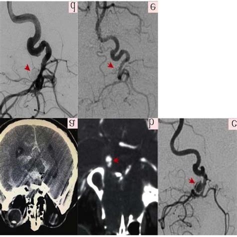 Right Vertebral Artery V4 Segment Dissection Aneurysm Treated With Lvis