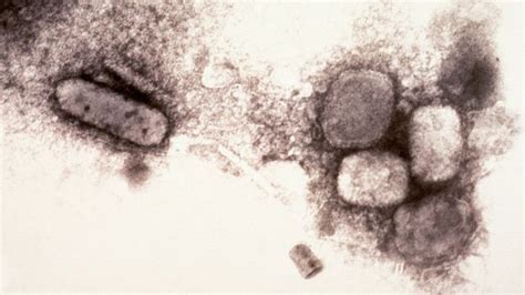 How Smallpox Claimed Its Final Victim Bbc News