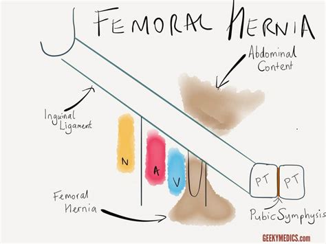 Inguinal And Femoral Hernias Inguinal Canal Anatomy Geeky Medics