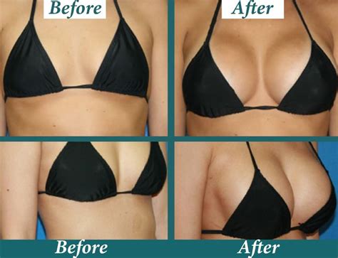 How Much Does Breast Implant Removal Cost Claudned