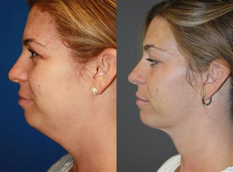 Neck Liposuction Before And After Pictures Boston Ma