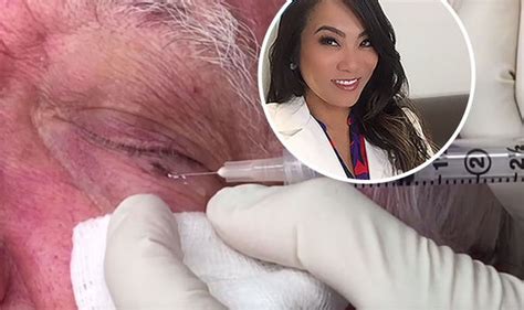 Pimple popper' has attracted millions of viewers with her gruesome footage of her patients' blackheads being extracted and their cysts being ruptured. WATCH: Dr Pimple Popper SQUEEZES giant blackhead from ...