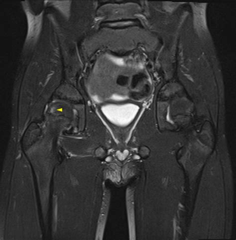 Sciatic Nerve Palsy Complicating Posterior Hip Dislocation In A Child