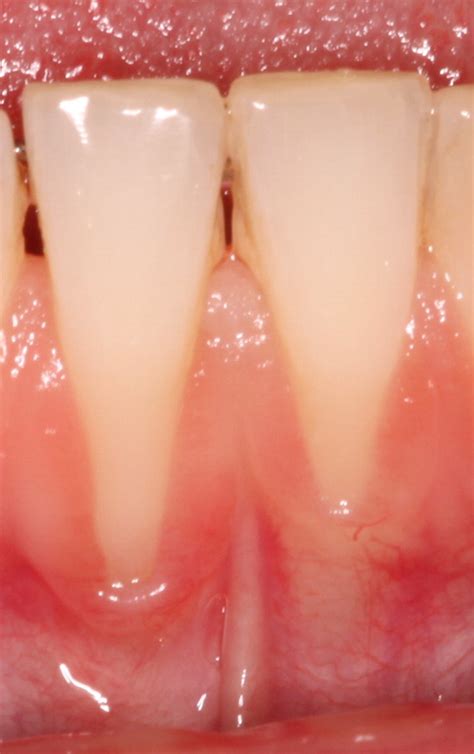 Management Of Gingival Recession In The Orthodontic Patient Seminars