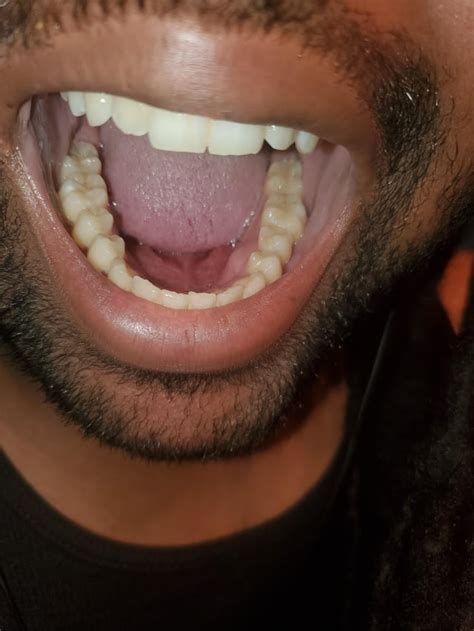 Hard Bony Painless Lump On One Side Of My Gums Noticed It A Couple