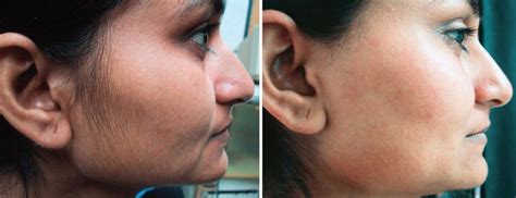 Causes Of Excess Facial Hair In Women Health Guru Magazine