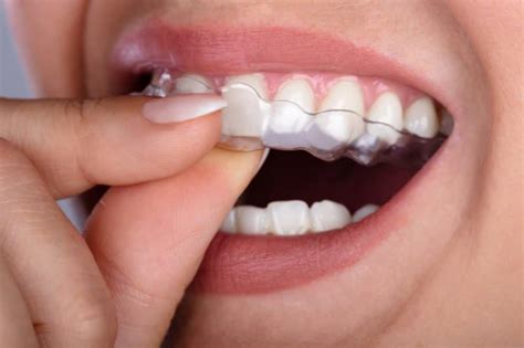 Clear Plastic Aligners Miami Fl Dentist Brickell Dental General