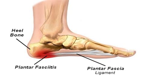Heel Pain On The Inside Of The Foot Ssor Physical Therapy