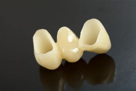 Dental Bridge Costs Types And More Uk Tooth Bridge Guide