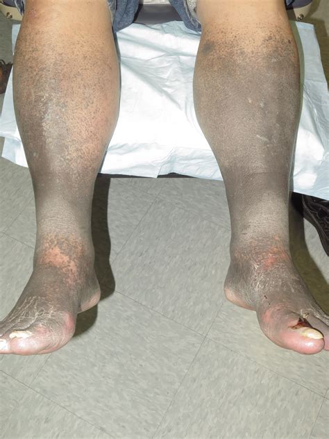 Cureus A Severe Case Of Minocycline Induced Hyperpigmentation Of The