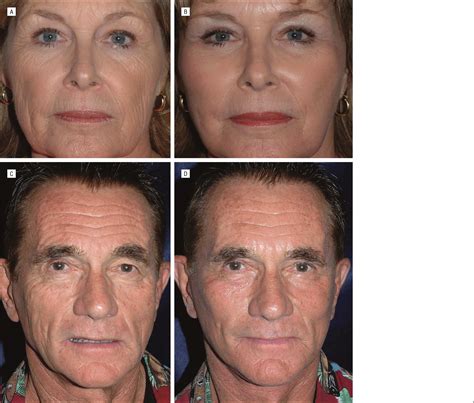 a simplified approach to midface aging jama facial plastic surgery jama network
