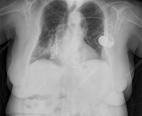 Pacemaker X Ray Stock Image C0564050 Science Photo Library
