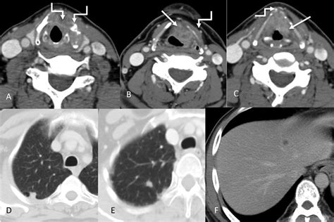 Transglottic Laryngeal Cancer Axial Ct Images Showing The Primary