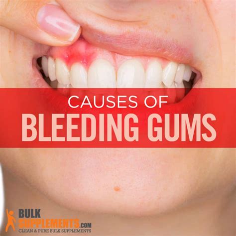 Bleeding Gums Characteristics Causes And Treatment