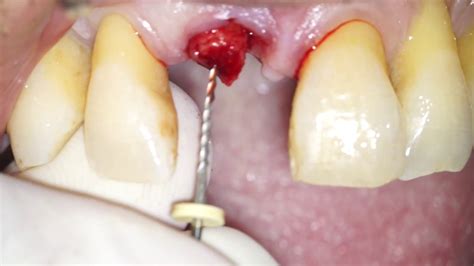 Atraumatic Root Extraction By Means Of An Endodontic File Dr Fabio
