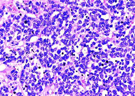 Merkel Cell Tumor Pathology Outlines Merkel Cell Carcinoma