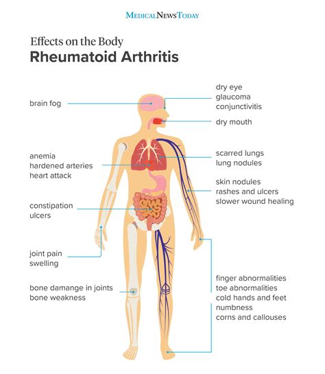 The most common respiratory diseases are acute respiratory infections, found in both adults and children. Effects of rheumatoid arthritis on the body