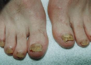 Plotseling ontdek je een soort van zwarte vegen op de muren en het plafond van je badkamer. Schimmelnagel | Voetverzorging.nl