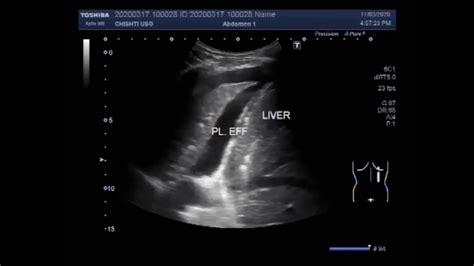 Ultrasound Video Showing Pleural Effusion With Collapsed Lung Tissue