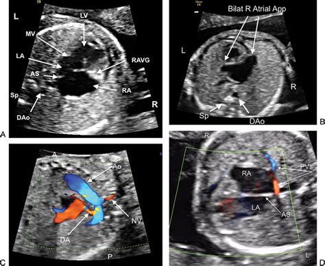 Prenatal Fetal Ultrasound Images A Four Chamber View Demonstrating