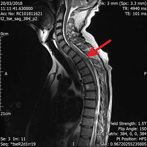 Spontaneous Spinal Subdural Haematoma In A Patient On Apixaban Bmj
