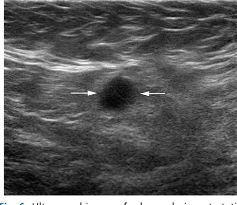 Figure 6 From Regional Lymph Node Staging In Breast Cancer The