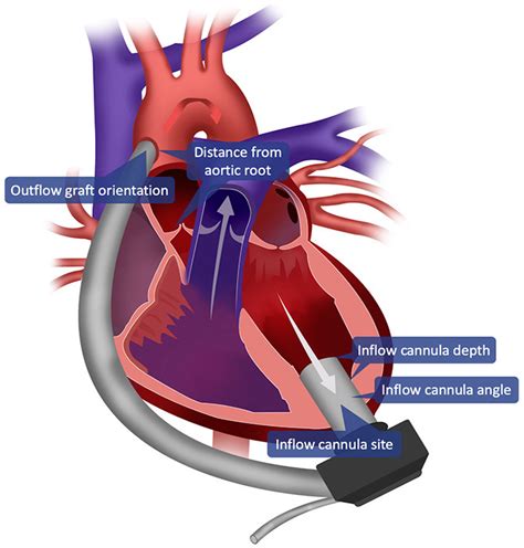 Jcm Free Full Text The History Of Durable Left Ventricular Assist