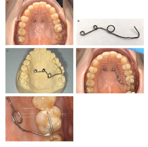 Pdf Maxillary Molar Intrusion Using Mini Implants In The Anterior Palate Mousetrap Versus