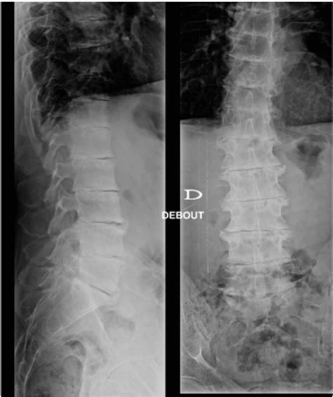 Lumbosacral Spine Radiograph Download Scientific Diagram