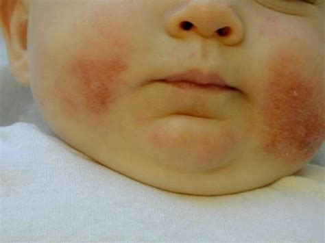 Dermatite Atopica Bambini Passione Mamma