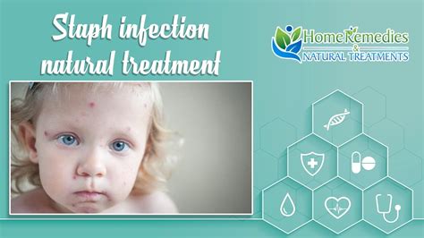 Natural Treatments And Home Remedies For Staph Infection Youtube