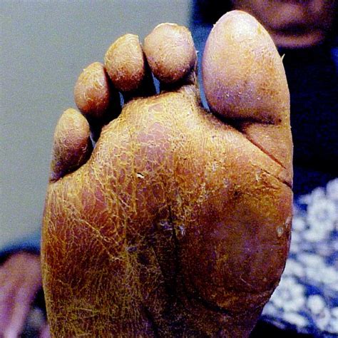 Collection Pictures Photos Of Diabetic Feet And Legs Updated