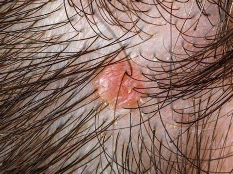 How To Stop Pimples On Scalp Causing Headache The Causes And Treatments