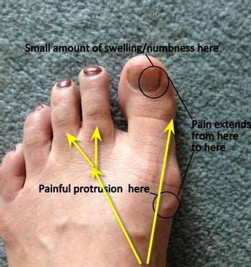 Corns develop because of abuse or stress. Pain from outer edge of big toe nail down to base of toe ...