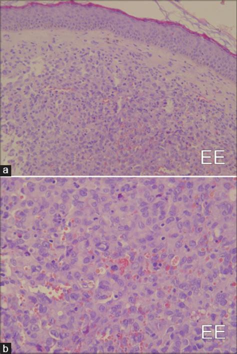 Other conditions may cause the same symptoms. Metastatic Merkel cell carcinoma of the face Vaccaro M ...