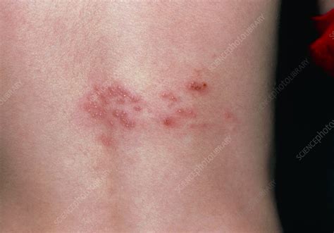 Rash Of Shingles Herpes Zoster On Lower Back Stock Image M2600106