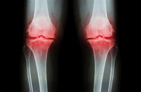 How To Bullet Proof Your Knees Biolayne
