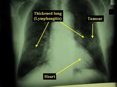 Medical Pictures Info Lung Cancer X Ray
